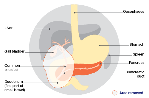  Before a whipple procedure