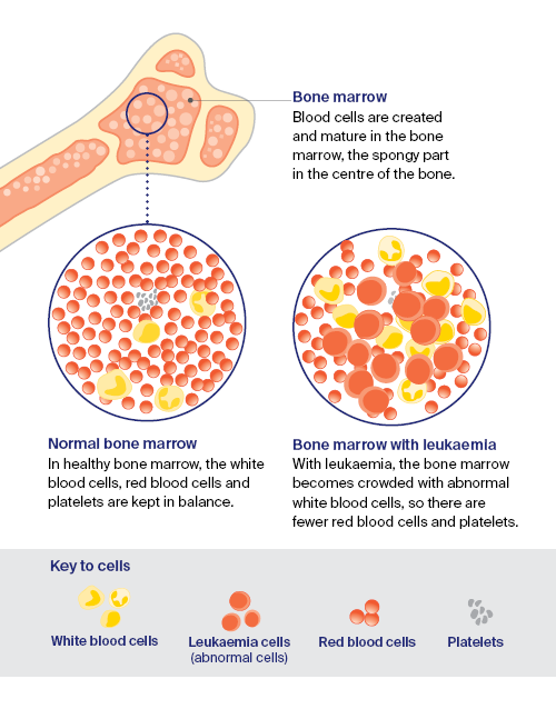 How leukaemia starts