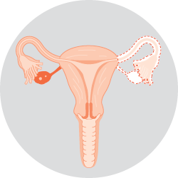 Unilateral salpingo-oophorectomy