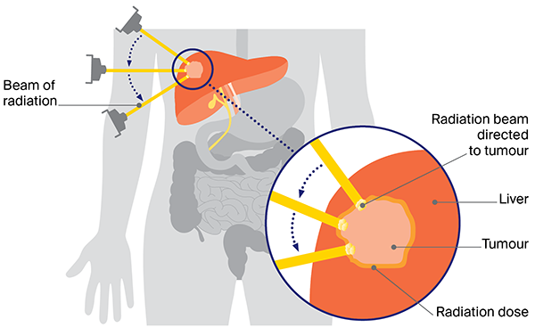 Diagram showing how Stereotactic body radiation therapy (SBRT) is done