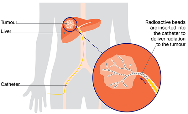 Diagram showing how selective internal radiation therapy (SIRT) is done