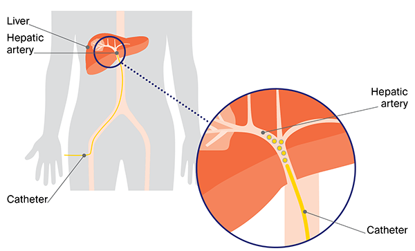 Transarterial chemoembolisation (TACE)