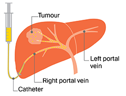 portal vein embolisation 01