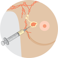 lymphatic mapping technique