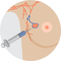 Blue dye injection technique