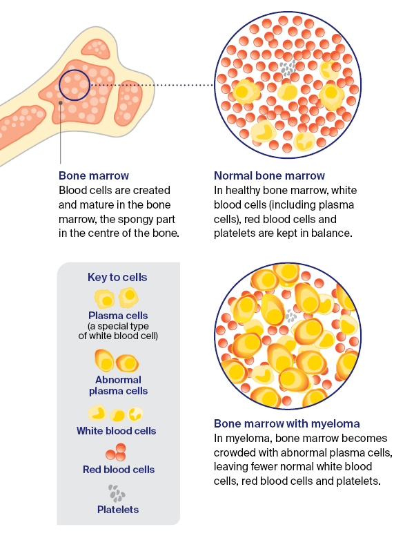 Diagram - what is blood cancer?