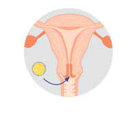 Step 5: Embryo transfer IVF