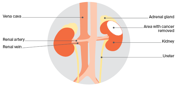 Diagram of Partial nephrectomy