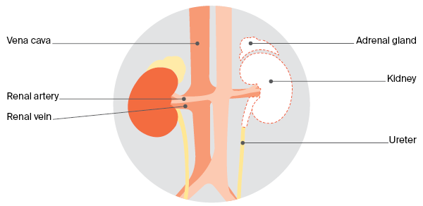 Diagram of Radical nephrectomy