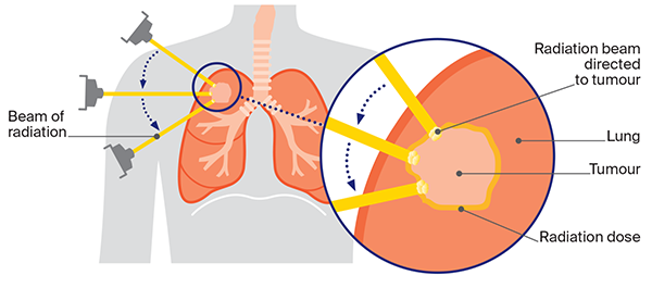 Radiation therapy for Lung Cancer