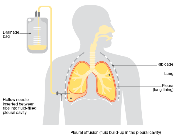 Having a plueral tap for mesothelioma