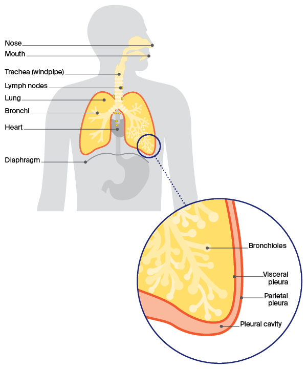 Diagram: How pleural mesothelioma affects
the pleura