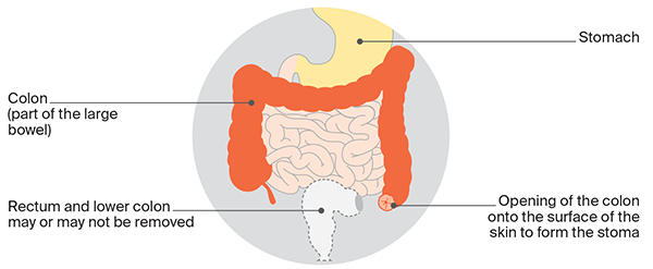 Colostomy