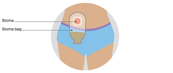 Stoma bag or appliance
