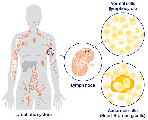 Diagram: How lymphoma starts