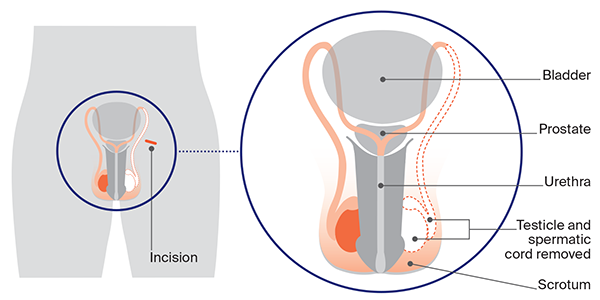 Diagram of having an orchidectomy