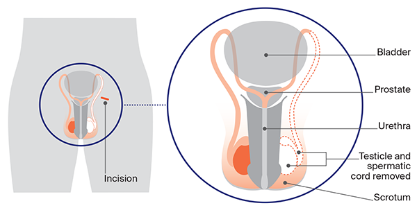 Diagram of having an orchidectomy. An orchidectomy is often done to confirm a diagnosis of testicular cancer. It is also the main treatment for testicular cancer.