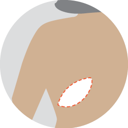 LD flap reconstruction
