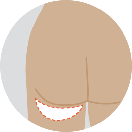 PAP flap reconstruction 