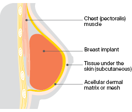 Prepectoral implant reconstruction 