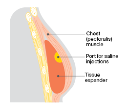 First stage implant tissue expander