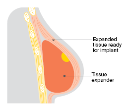 Second stage expanding tissue expander