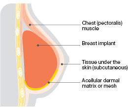 Subpectoral implant reconstruction