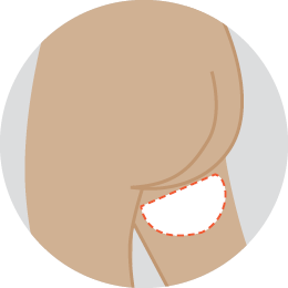 TMG or TUG flap reconstruction