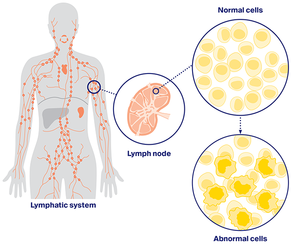 Image of the body's lymphatic system and how lymphoma starts