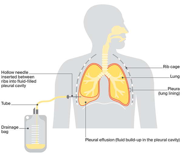 In pleural mesothelioma, a pleural tap (also known as pleurocentesis or thoracentesis) drains fluid from around the lungs.
