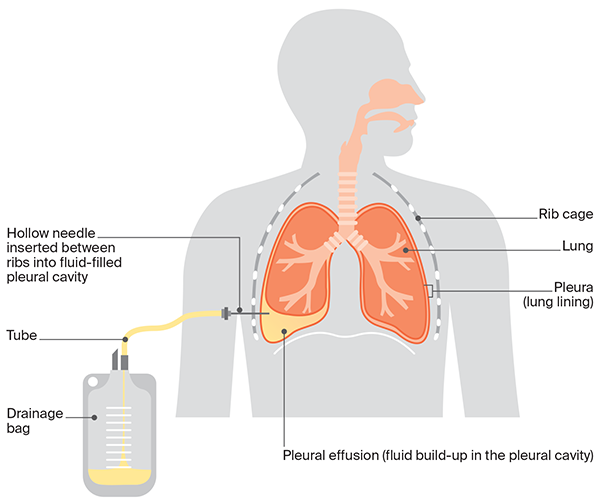 pleural tap
