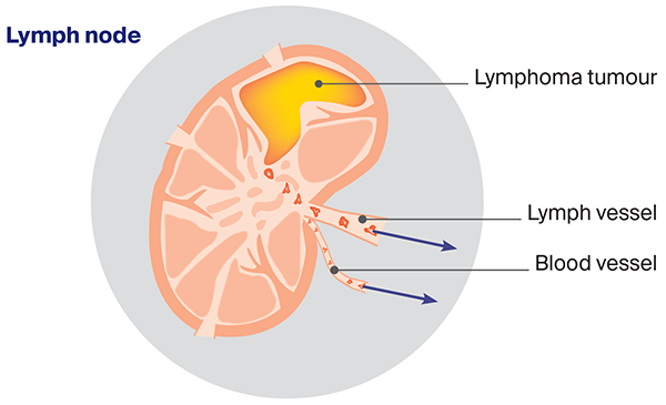 Diagram: How lymphoma spreads