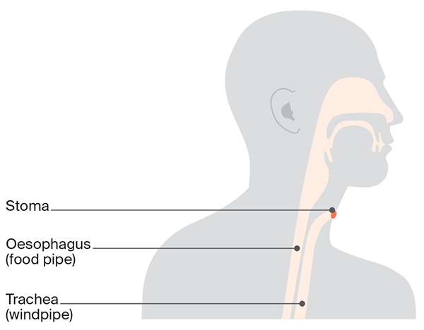 Diagram of laryngectomy stoma