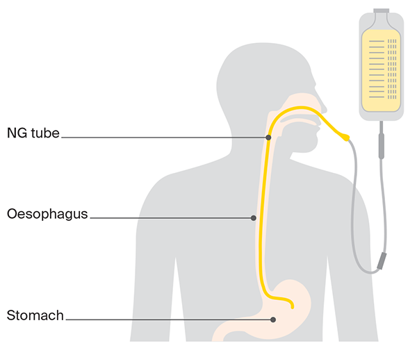 Diagram of a temporary feeding tube