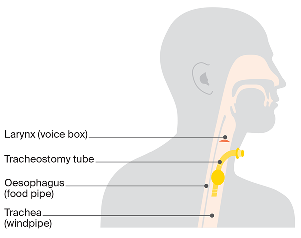 Diagram of tracheostomy