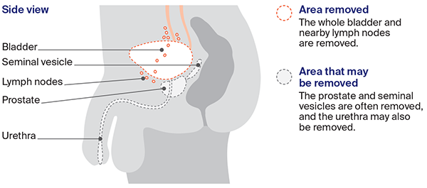 Diagram: Cystectomy in males