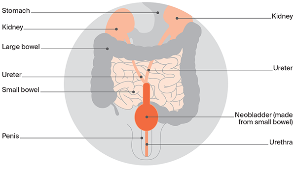 Diagram of neobladder: In this method, a pouch is created from a portion of your small bowel and placed in the same area as your original bladder. This pouch is called a neobladder. 