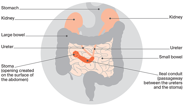 Diagram: Urostomy. Also known as an ileal conduit, a urostomy is the most common type of urinary diversion. In a urostomy, urine will drain into a bag attached to the outside of the abdomen. 