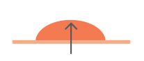 Signs of melanoma - Elevated