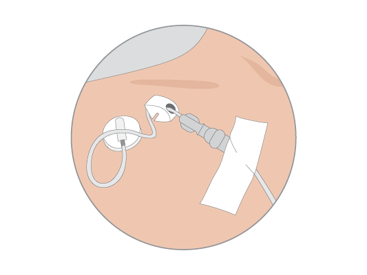 Image of someone having chemotherapy through a vein in their chest.