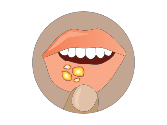 Image of mouth with sores.