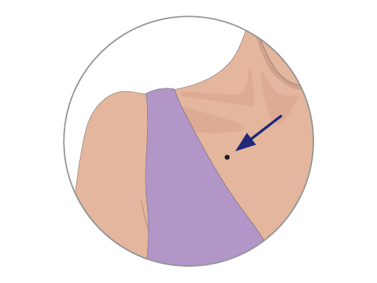 Image of marks put on your skin to make sure you have radiation therapy in the same place every time.