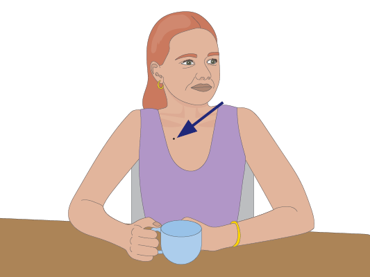 Image of woman with permanent mark from radiation therapy.