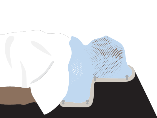 Image of person wearing a special mask during radiation therapy treatment.
