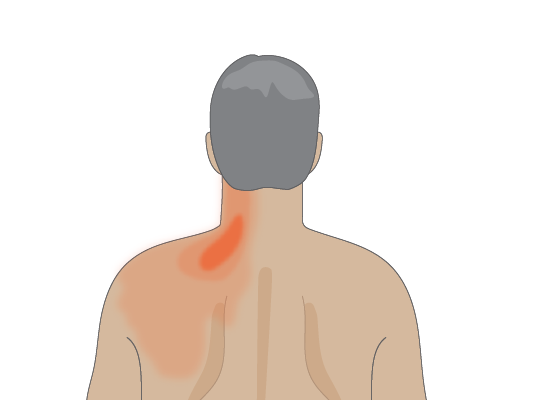 Image of man with red spots on skin.