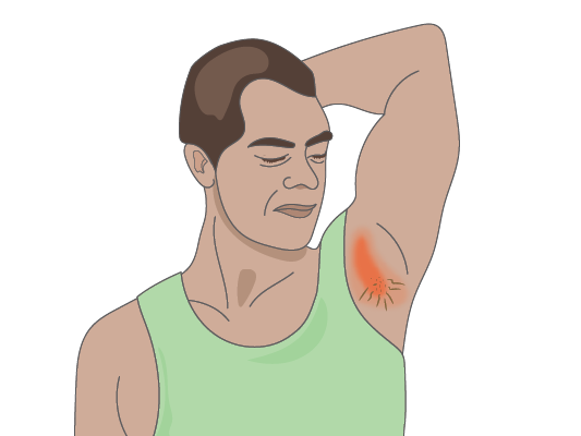 Image of a man with hair falling out as a result of radiation therapy.