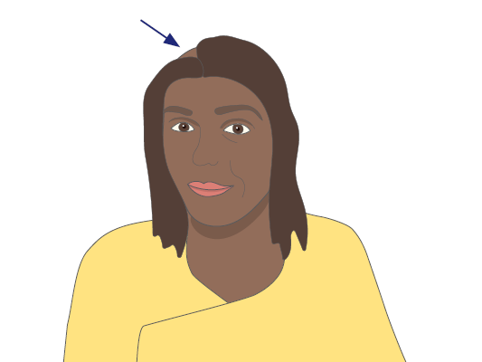 Radiation therapy to the head may cause a small patch of hair to fall out.