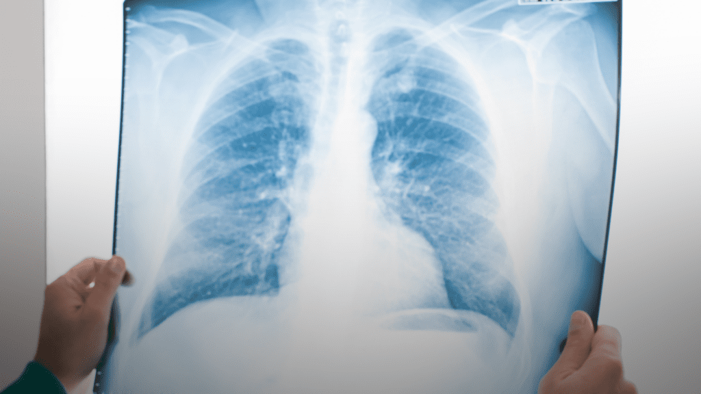 A photo of a person holding a chest X-ray image showing the lungs, used for lung cancer screening.