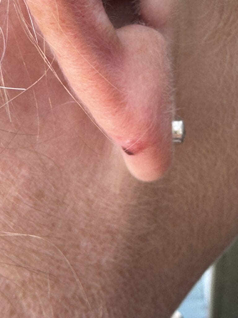 The back of Jenny's right ear with a small dark lump towards the back of her lobe.