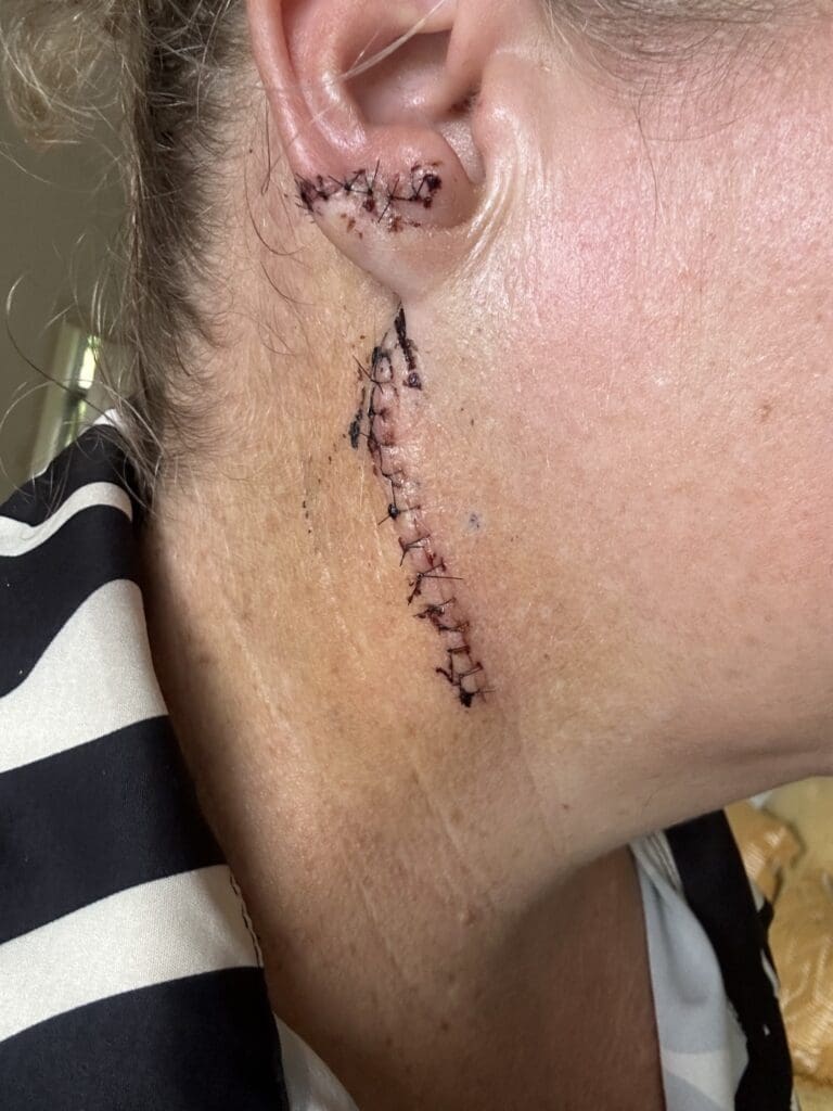 The right side of Jenny's face post her surgery. Multiple stiches appear in her ear and down the side of her neck.